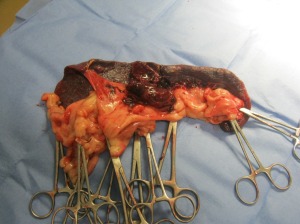Tumor of the spleen that required surgical removal 